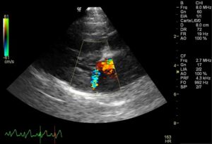 Régurgitation  mitrale  visible  au  Doppler  couleur lors de maladie  valvulaire dégénérative  chez un chien