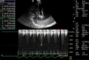 Régurgitation tricuspidienne visible au doppler continu évoquant une hypertension artérielle pulmonaire débutante chez un chien