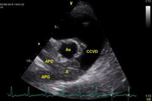 Thrombus impressionnant a la bifurcation du tronc pulmonaire