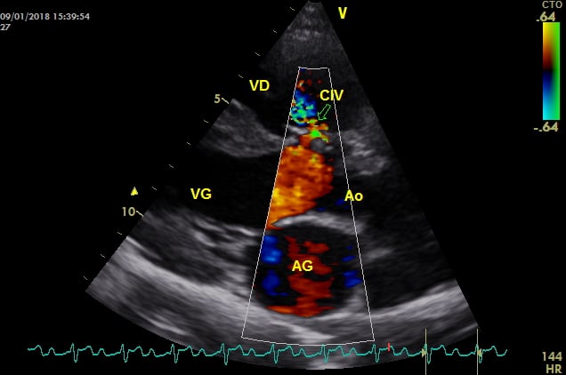 Cardiologie Lyon Une communication inter-ventriculaire en couleur