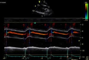 Cardiologie vétérinaire lyon. Une insuffisance aortique en mode temps mouvement en couleur